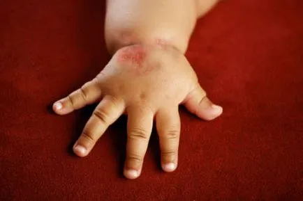 Dermatita atopica la copii, tratament, simptome, si medicamente
