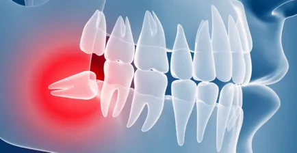 Премахване на повлияха мъдреци - указания за реда, етапите и прегледи след отстраняване