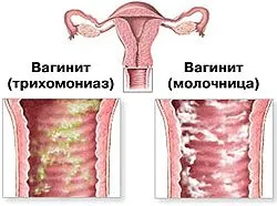 менструації