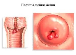 білі виділення перед місячними