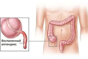 причини болю живота після місячних
