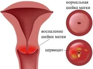 менструації