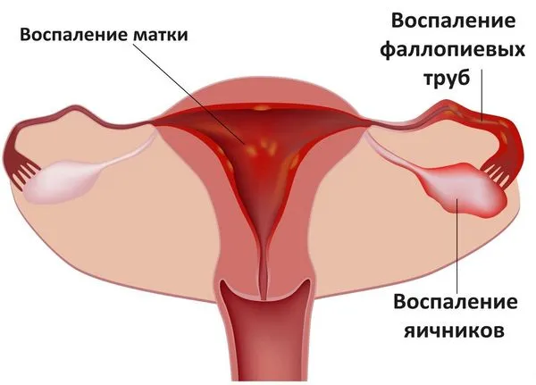 Чому під час місячних болить живіт (місячних) живіт