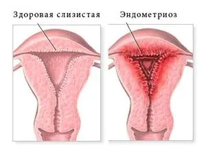Що за кров'янисті виділення після статевого акту? (при вагітності) статевих органів