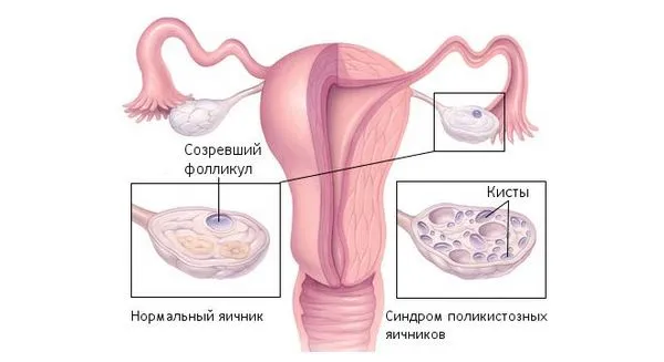 Що робити, якщо затримка місячних у підлітка: рекомендації лікарів (місячні) менструальним циклом