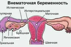 місячні під час позаматкової вагітності