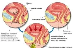 перший по циститу