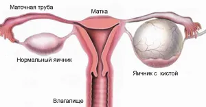 менструації