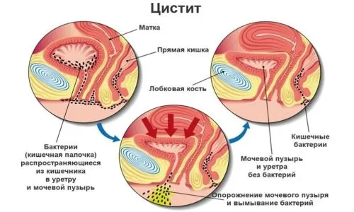 Цистит під час і після місячних: причини, симптоми, лікування, профілактика (місячних) місячні