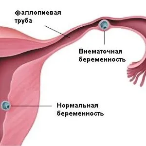 менструації