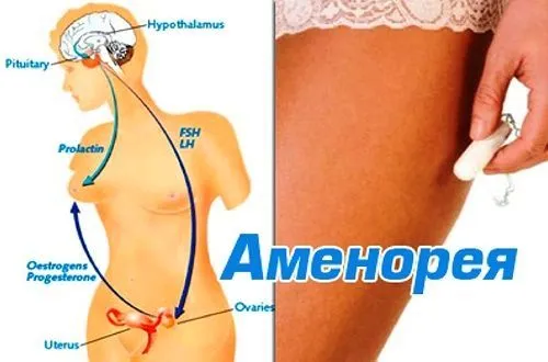 Аменорея – відсутність менструацій: причини, симптоми, діагностика, лікування (менструації) місячних