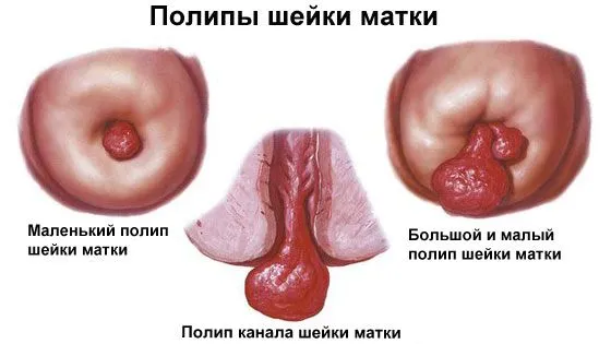 кровотеча