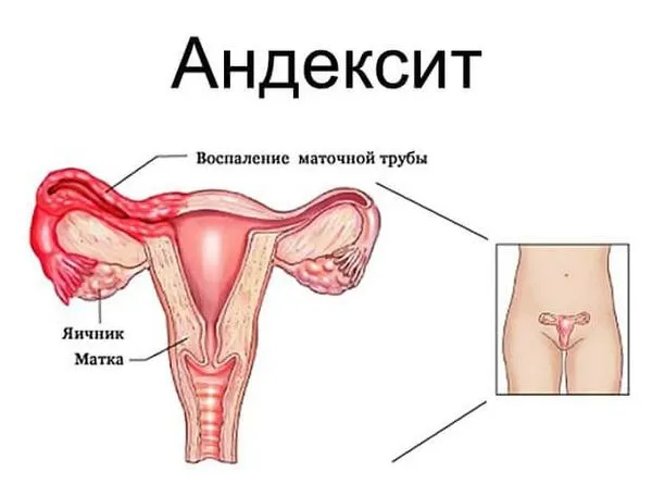 біль яєчників під час місячних