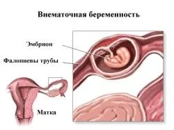 позаматкова вагітність місячні