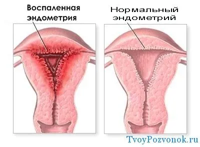 Після місячних болить низ живота і поперек: причини і симптоми (внизу живота) внизу живота