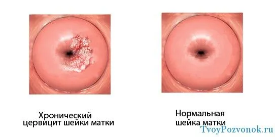 Після місячних болить низ живота і поперек: причини і симптоми (гормональний фон) болить живіт після місячних