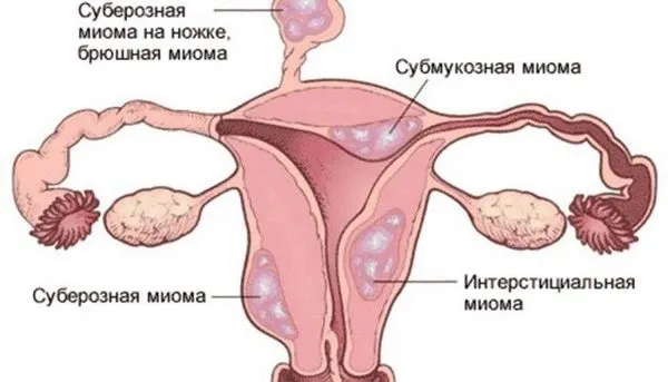 Кровотеча при місячних: як зупинити рясну крововтрату? (місячні) менструальний цикл