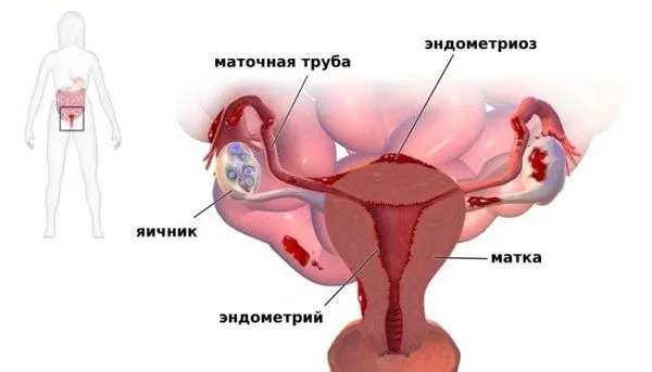 нерегулярні місячні причини