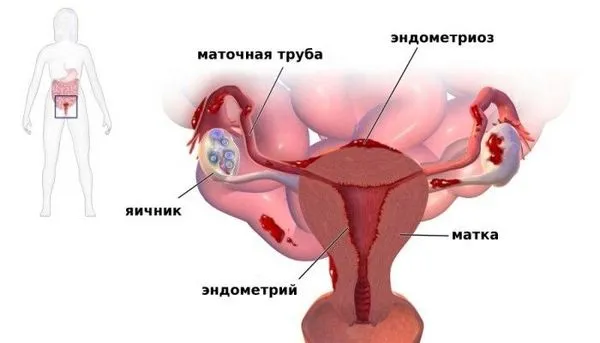 Місячні коричневі: причини, чому місячні коричневого кольору, чорні, густі виділення, коричнева кров (місячні) якщо місячні коричневі