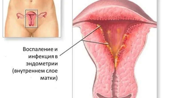 Місячні коричневі: причини, чому місячні коричневого кольору, чорні, густі виділення, коричнева кров (місячних) менструації