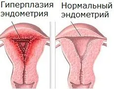 Причини коричневих виділень перед і після місячних (менструації) менструальний цикл