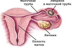 Виділення при затримці місячних (виділення перед місячними при вагітності) місячні