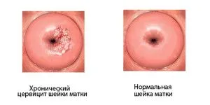 Сірі виділення після місячних (менструального циклу) менструального циклу