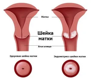 Розміри матки під час, до і після менструації (менструальний цикл) буває овуляція під час місячних