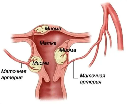 згустки крові при місячних