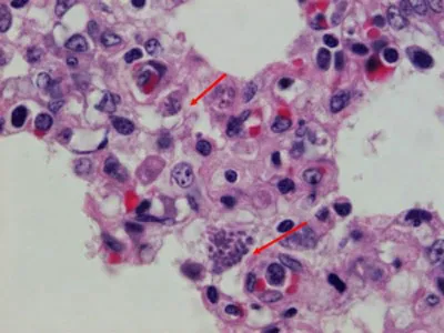 Ureaplasma при жените, лечението на комплекса и антибактериално