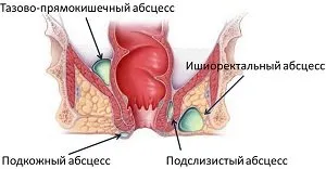 Причини, симптоми, лечение и профилактика на остър парапроктит