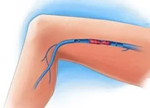Тромбоза на дълбоките вени на долните крайници, симптоми, лечение и рехабилитация