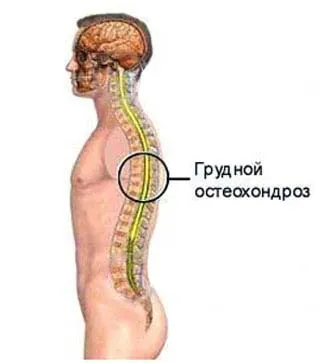 Остеохондроза на гръдния кош, симптоми и методи на лечение