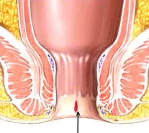 Пукнатина в ануса: причини, симптоми и основни принципи на лечение