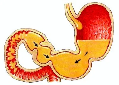 Рефлуксен гастрит (жлъчен, повърхностен) какво е това, симптоми, лечение, диета