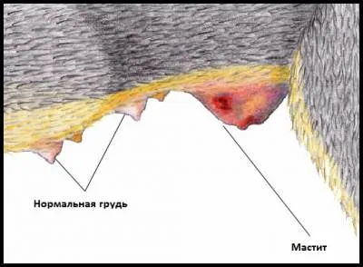 мастит