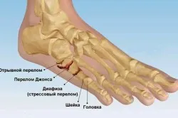 Picior valgus fara tratament chirurgical