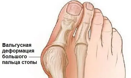 Foot Valgus деформация без лечение хирургия