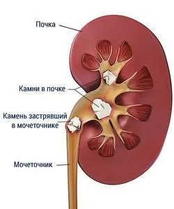 Видове камъни в бъбреците и техните причини