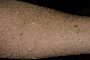 epidermodysplasia