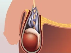 Разширени вени на тестисите как да се