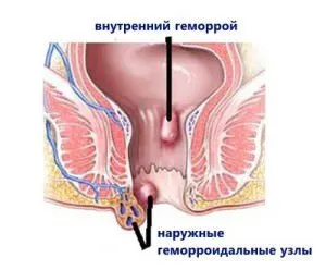 Как да лекувате външни хемороиди, без да напускате дома