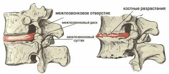 Симптоми и лечение на лумбална спондилоза