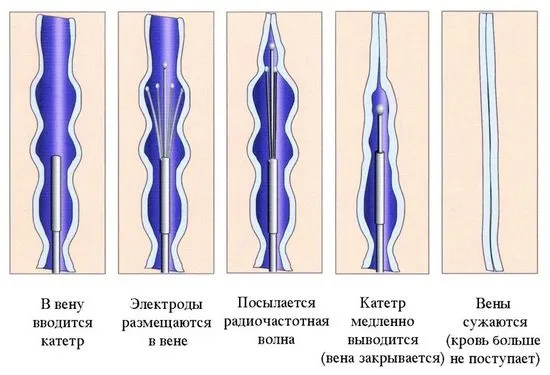 вени