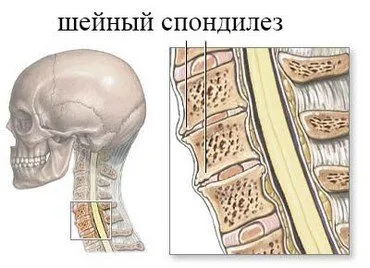 Симптоми и лечение на цервикална спондилоза