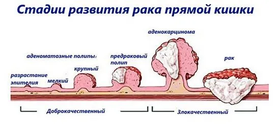 Как се извършва операция за отстраняване на ректума