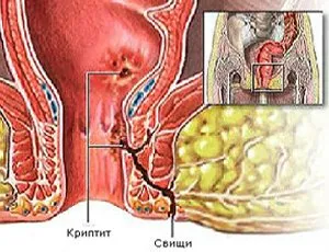 Какво е криптит на ануса, симптоми, лечение, снимка на заболяването