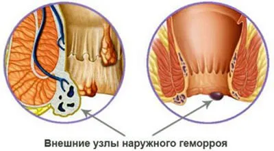 Къде се появи подутината в ануса