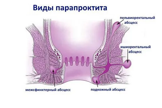 парапроктит