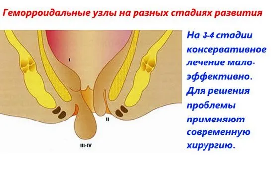 Методи за лечение на хемороиди в 4-ти етап на развитие